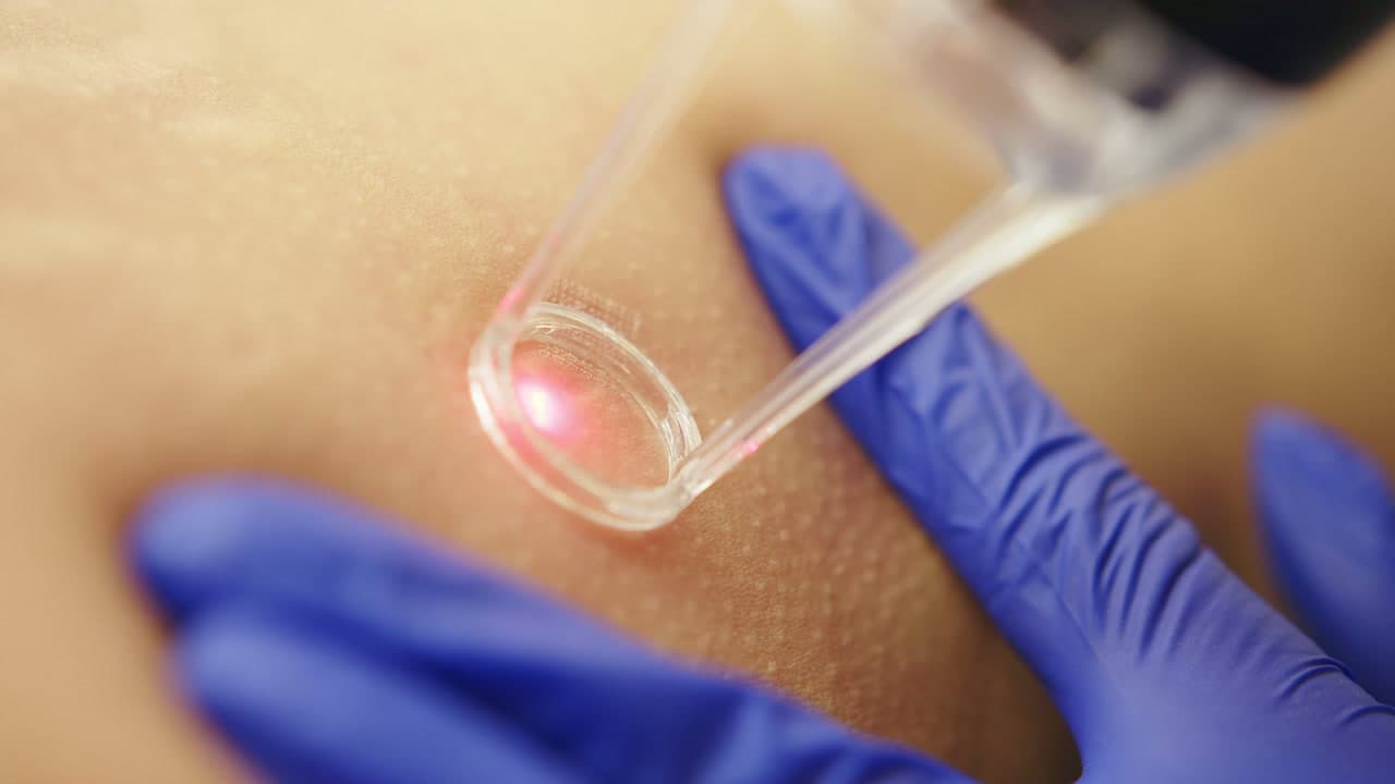 Aplicação de laser na pele com manuseio do equipamento por profissional usando luvas